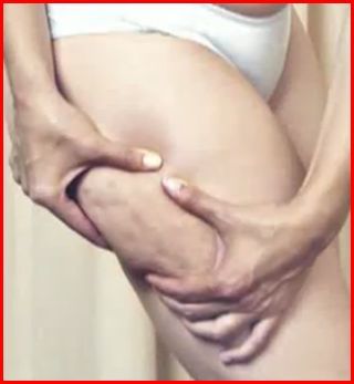 cellulit10.jpg