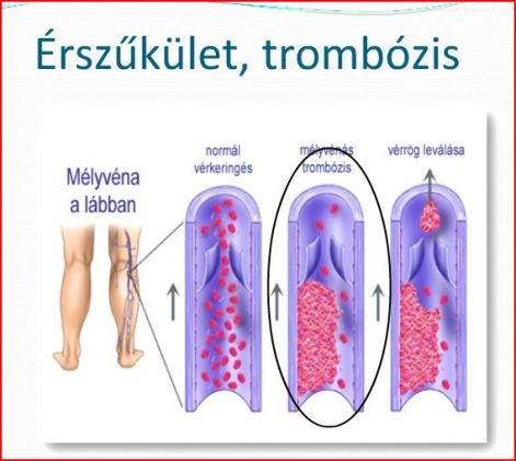 érszűkölet, trombózis, vérrögök